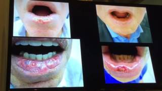 Queilitis actinica Como lo maneja usted Bucaramanga 2016 [upl. by Ellertal859]