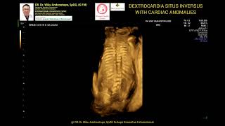 Dextrocardia Situs Inversus 24 weeks [upl. by Dasa]