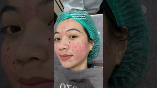 kombinasi treatment bopeng  Subcision combine Rejuran scars SozoSkinClinic [upl. by Nylirac]