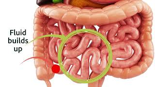 Osmotic laxatives exhibit a linear dose response [upl. by Noterb753]