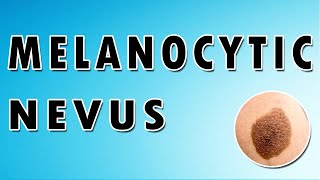 Melanocytic Nevus Symptoms Treatment and Causes [upl. by Irec]