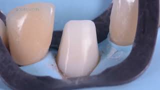 Fiber reinforced Postfree core building for dental crowns [upl. by Libyc]