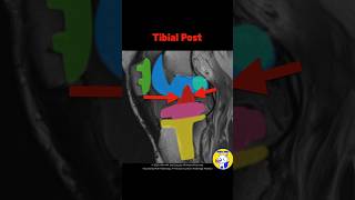 Fig 5D04 MRI Findings of Posterior Stabilized TKA Part 2 [upl. by Moonier]