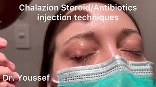 Chalazion Easiest and simplest Treatment with Steroid and Antibiotic Injections [upl. by Lambart]