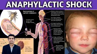 anaphylactic shock anaphylactic shock in Hindi circulatory diseases  treatment [upl. by Nisay]