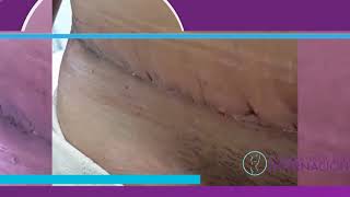 Abdominoplastia  Proceso de cicatrización [upl. by Arch]