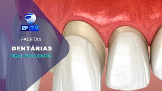 RF com Você  Facetas Dentárias especialista explica as principais dúvidas sobre o assunto [upl. by Oman]