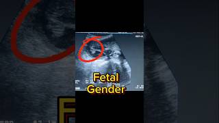 Easy Fetal Ultrasound  Gender Revealing  Anomaly Scan  3rd Trimester Third [upl. by Trstram]