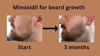 My results from using minoxidil for beard growth [upl. by Secnarf257]