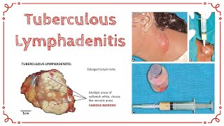 TUBERCULOUS LYMPHADENITIS  Stages Of TB Lymphadenitis  Cold Abscess  General Surgery [upl. by Netta]