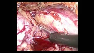 Laparoscopic partial nephrectomy Twist technique [upl. by Nolubez]