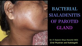 Bacterial Sialadenitis of parotid gland  An interesting case report [upl. by Gonagle]