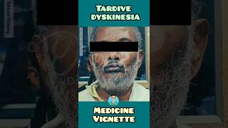 Tardive Dyskinesia real clinical video for USMLE NEET PG NCLEX INICET medical clinical video [upl. by Santoro]