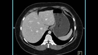 Abdomen Liver Focal Nodular Hyperplasia CT Angiography5 of 6 [upl. by Aaronson850]