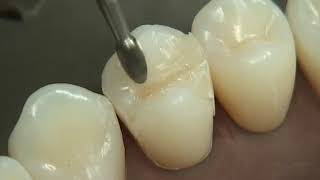 Class II Composite Preparation amp Restoration  Operative Dentistry [upl. by Eetsirhc]