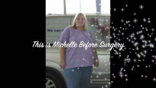 Weight Loss Journey with the Gastric Sleeve [upl. by Liahkim596]