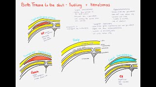 Caput Succedaneum Cephalohematoma Subgaleal Hemorrhage [upl. by Motch918]