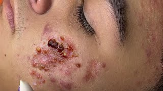 Big Cystic Acne Blackheads Extraction Blackheads amp Milia Whiteheads Removal Pimple Popping  1523 [upl. by Dedra]