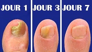 Guérissez votre mycose en 7 jours avec de lail  Allez Santé [upl. by Favian]