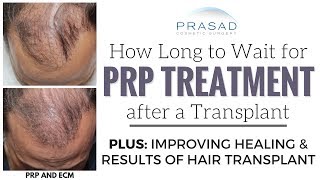 Safe Timing of PRP Scalp Injections After a Hair Transplant and a Single Treatment PRP Combination [upl. by Mooney]