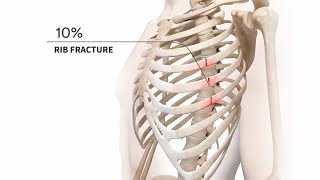 Management of Acute and Chronic Rib Fractures [upl. by Aitas]