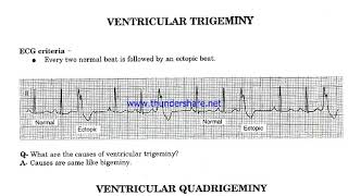 Ventricular Bigeminy Trigeminy amp Quadrigeminy [upl. by Alitta]