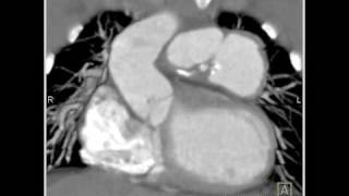 Cardiac pseudoaneurysm arising off the aorta near a zone of prior surgery 2 of 5 [upl. by Gombach637]