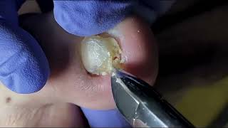 Ingrown Toenail Removal  Pedicure Treatment and Very Satisfying  Best Satisfying Nail Cutting [upl. by Naicad687]