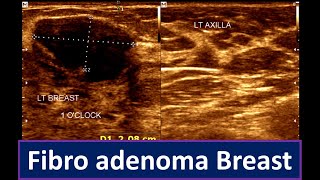 Fibroadenoma Breast Breast Lump  Brest ultrasonogram [upl. by Nan]