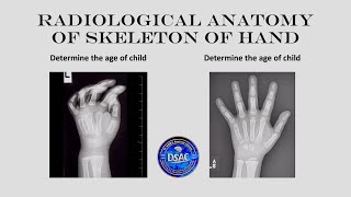 Age estimation from X Ray Radiological anatomy of hand Ossification of carpal amp metacarpal bones [upl. by Naresh667]