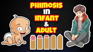 Stages Of Phimosis In Infant and Adulthood [upl. by Vig880]