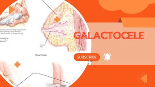 GALACTOCELECAUSES SYMPTOMS AND TREATMENTA MUST WATCH [upl. by Lamar505]