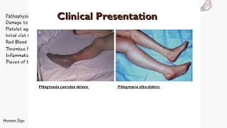 Phlegmasia Cerulea Dolens VS Phlegmasia Alba Dolens  Deep Vein Thrombosis  Signs and Symptoms [upl. by Chesna883]