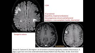 69 ICAA and ABRA CAA related inflammation amyloid beta related angiitis encephalopathy elderly [upl. by Kenrick448]