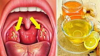 How to Cure Tonsillitis Fast and Naturally [upl. by Finer]