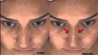 Rinoplastia  Simulación 3D  Dr Alejandro Afanador [upl. by Corabelle]