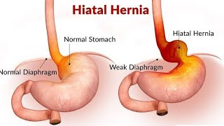 HIATAL HERNIA CAUSES SYMPTOMS AND MANAGEMENT BSCGNM NURSING dailypost [upl. by Lobel]