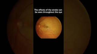 What are there different types of eye strokes [upl. by Fraser]