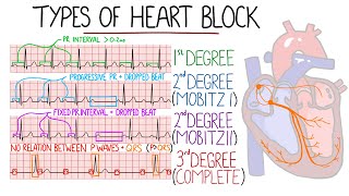 Heart Blocks Made Easy  1st 2nd Mobitz 1Wenckebach amp Mobitz 2 3rd Complete  with ECGs [upl. by Winne]