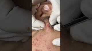 Squeezing hidden pimples [upl. by Akcimat]