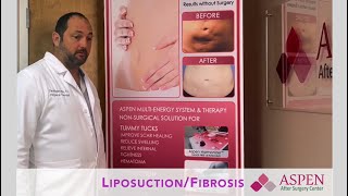 Liposuction Contour Irregularity  Stubborn Lipo Lumps and Bumps Treatment [upl. by Rammus942]