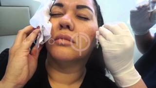 Radiesse Soft Tissue Filler Cheek Augmentation  Filler to Cheeks  Non Invasive Facial Contouring [upl. by Ahsimin]