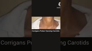 Corrigans Pulse  Dancing Carotids  Collapsing Pulse  water Hammer Pulse [upl. by Droffig]