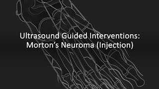 ultrasound Guided Interventions mortons injection fyp sportsmedicine sportsdoctor [upl. by Emlynn340]