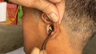 Removing ear blockage use manual tools [upl. by Tyre]