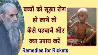 सूखा रोग के कारणलक्षण ओर इलाज  Rickets Causes Symptoms  Swasthya Vichar [upl. by Moscow587]