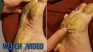 Removing Extremely Hard Foot Callus 🦶 The right way to remove foot callus FULL TREATMENT 06 [upl. by Jacobo]