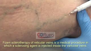 Foam sclerotherapy for treating spider veins and varicose veins [upl. by Nelac]