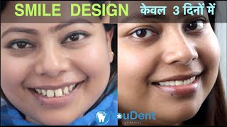 Teeth Gap Treatment in 5 Days I Zirconia Cap I Best Smile Design Dentist in INDIA youdent ​ [upl. by Player]