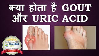 Gout and Uric Acid Hindi [upl. by Kliber498]